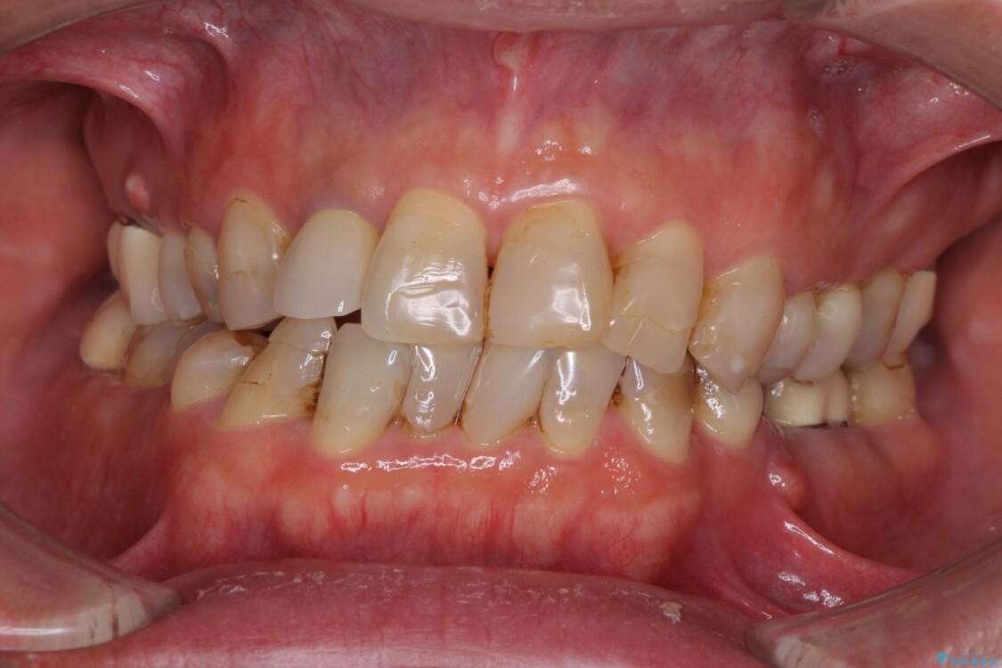 歯列不正と歯周病　総合歯科治療による全顎治療 治療前