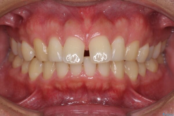 上顎の出っ歯とすきっ歯　補助装置を用いたインビザライン矯正 ビフォー