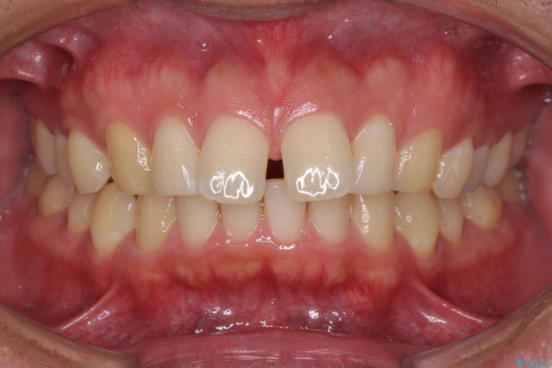 上顎の出っ歯とすきっ歯　補助装置を用いたインビザライン矯正 治療前