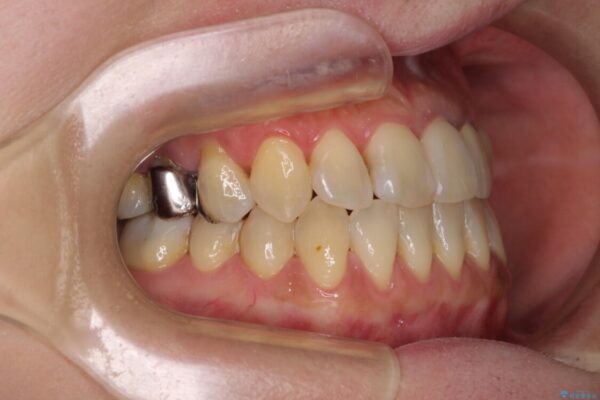 反対咬合で痛む前歯を改善　インビザラインによる矯正治療 治療後画像