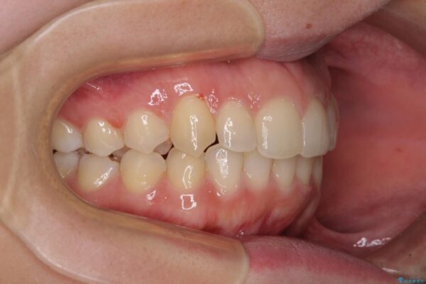 骨格的に左右にずれいている　前歯のデコボコをインビザラインで解消 治療後画像