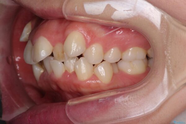 著しい叢生と顎骨のズレ　ワイヤー装置による抜歯矯正 治療前画像