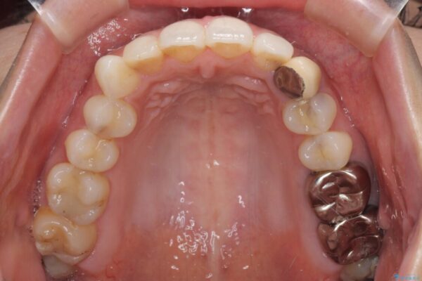 保険診療の変色したクラウン　前歯の審美歯科治療 治療前画像