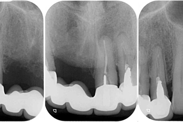 話しにくく見栄えの悪い前歯　オールセラミックブリッジ 治療前画像