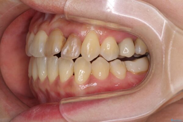 反対咬合で痛む前歯を改善　インビザラインによる矯正治療 治療途中画像