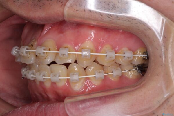 歯列全体のクロスバイトを治したい　ワイヤー装置による矯正治療 治療途中画像