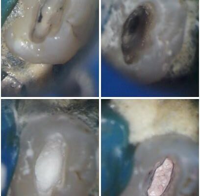 神経が死んで変色した歯　根管治療とオールセラミッククラウン 治療途中画像