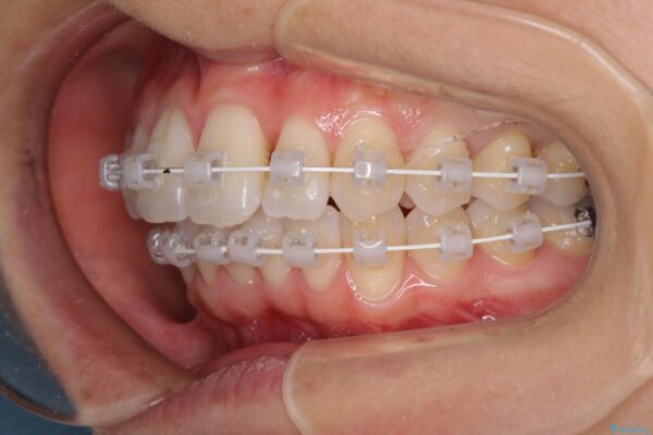短期間で仕上げたい　ワイヤーでの非抜歯矯正 治療途中画像