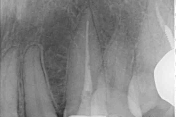 保険診療の変色したクラウン　前歯の審美歯科治療 治療後画像