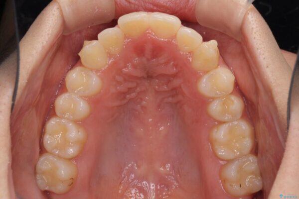 骨格的に左右にずれいている　前歯のデコボコをインビザラインで解消 治療途中画像