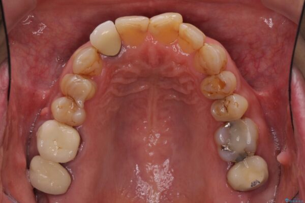 歯列不正と歯周病　総合歯科治療による全顎治療 治療前画像