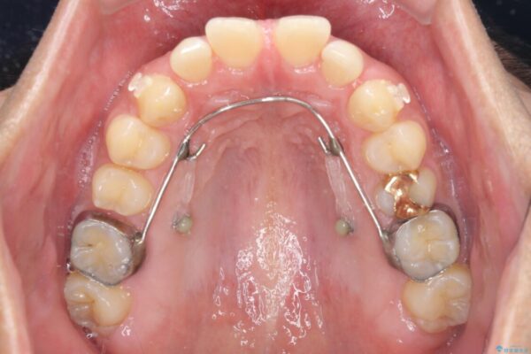 上顎の出っ歯とすきっ歯　補助装置を用いたインビザライン矯正 治療途中画像