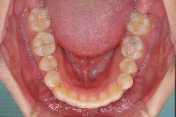 狭い歯列と前歯のデコボコ　インビザラインによる矯正治療 治療途中画像