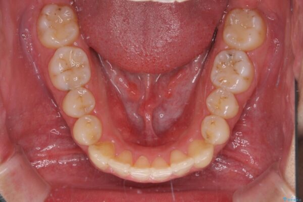 狭い歯列と前歯のデコボコ　インビザラインによる矯正治療 治療後画像