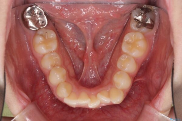 骨格的に左右にずれいている　前歯のデコボコをインビザラインで解消 治療前画像