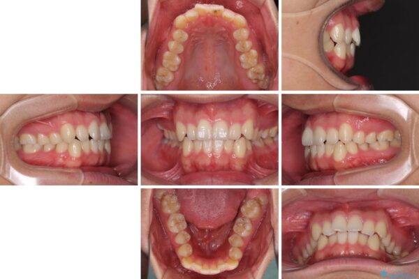 狭い歯列と前歯のデコボコ　インビザラインによる矯正治療 治療前画像