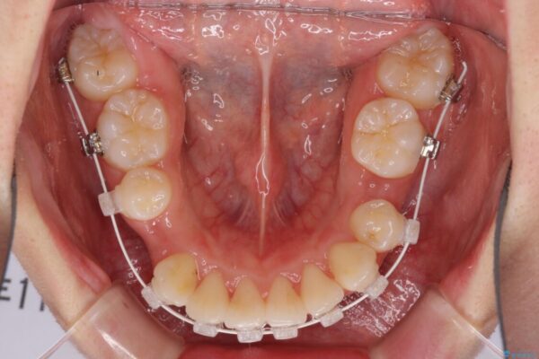著しい叢生と顎骨のズレ　ワイヤー装置による抜歯矯正 治療途中画像