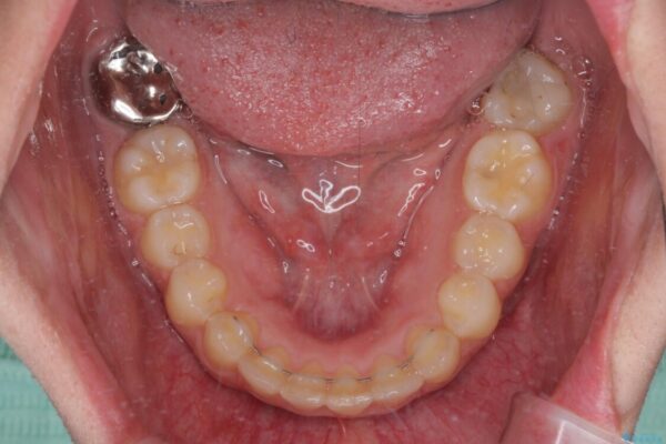 骨格的に左右にずれいている　前歯のデコボコをインビザラインで解消 治療後画像