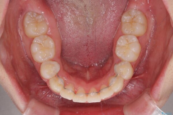 著しい叢生と顎骨のズレ　ワイヤー装置による抜歯矯正 治療後画像