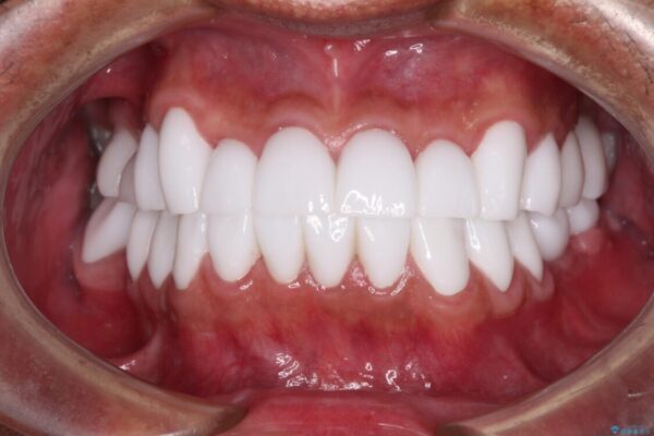 とにかく作り物のような真っ白な歯にしたい　フルジルコニアクラウンによる補綴治療 アフター