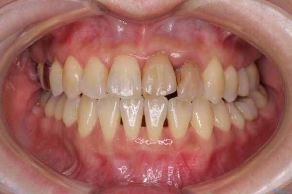 反対咬合で痛む前歯を改善　インビザラインによる矯正治療 治療途中画像