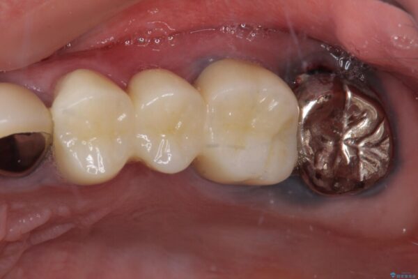 目立つ銀色の奥歯をセラミックに　セラミックブリッジ 治療後画像