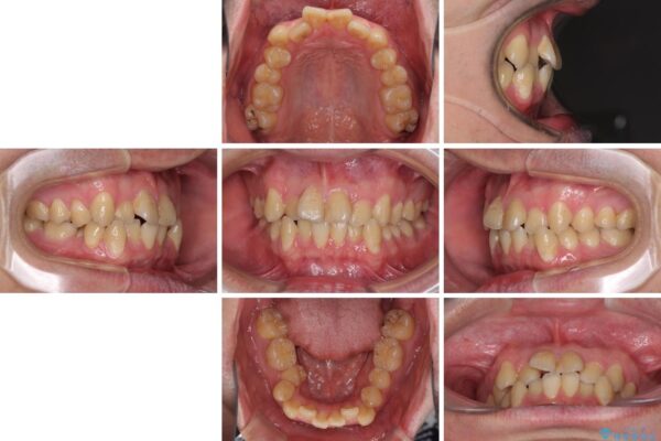 歯列全体のクロスバイトを治したい　ワイヤー装置による矯正治療 治療前画像