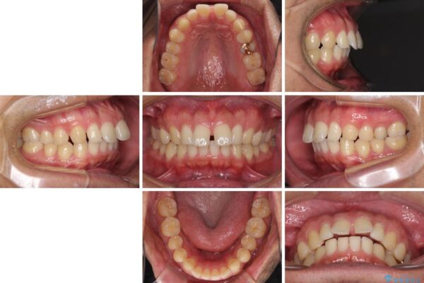 上顎の出っ歯とすきっ歯　補助装置を用いたインビザライン矯正 治療前画像