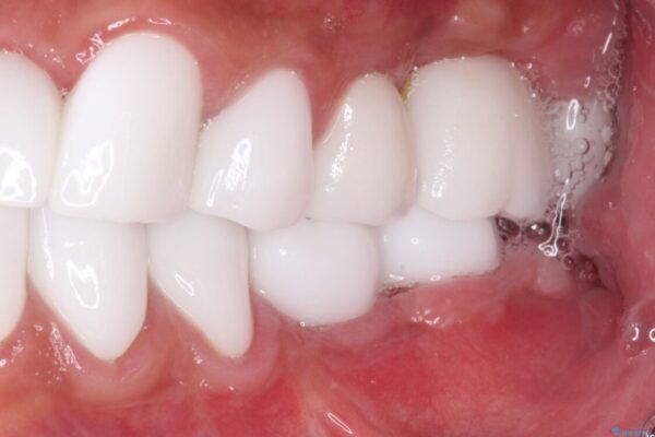 とにかく作り物のような真っ白な歯にしたい　フルジルコニアクラウンによる補綴治療 治療後画像