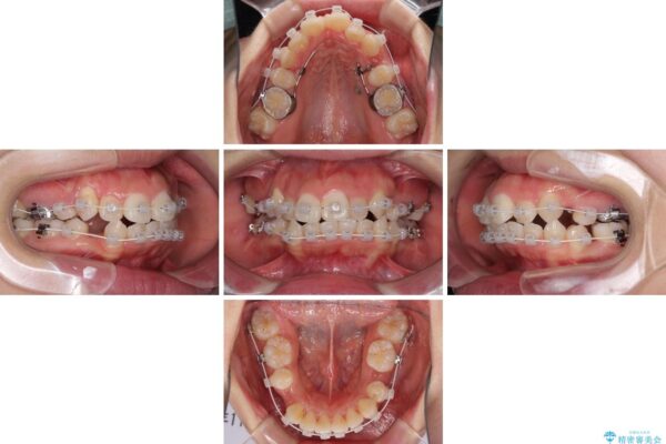 著しい叢生と顎骨のズレ　ワイヤー装置による抜歯矯正 治療途中画像