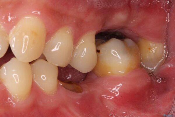 とにかく作り物のような真っ白な歯にしたい　フルジルコニアクラウンによる補綴治療 治療前画像