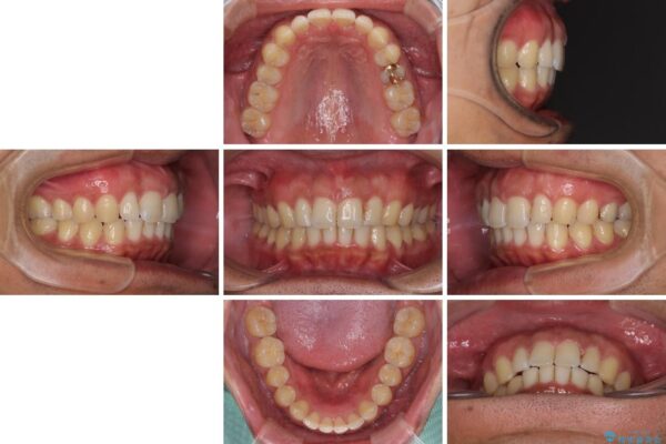 上顎の出っ歯とすきっ歯　補助装置を用いたインビザライン矯正 治療後画像