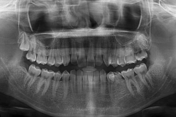 乳歯を抜いてインプラントに　咬み合わせ改善のインビザライン矯正 治療前画像