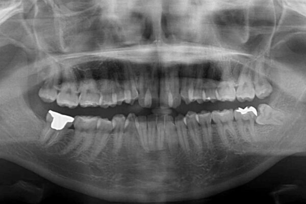 骨格的に左右にずれいている　前歯のデコボコをインビザラインで解消 治療前画像