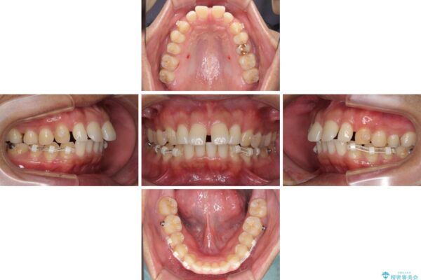 上顎の出っ歯とすきっ歯　補助装置を用いたインビザライン矯正 治療途中画像