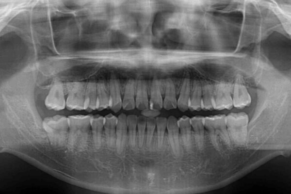 歯列全体のクロスバイトを治したい　ワイヤー装置による矯正治療 治療後画像