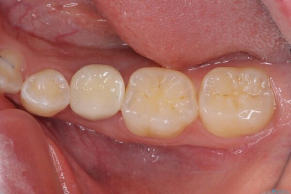 乳歯を抜いてインプラントに　咬み合わせ改善のインビザライン矯正 治療後画像