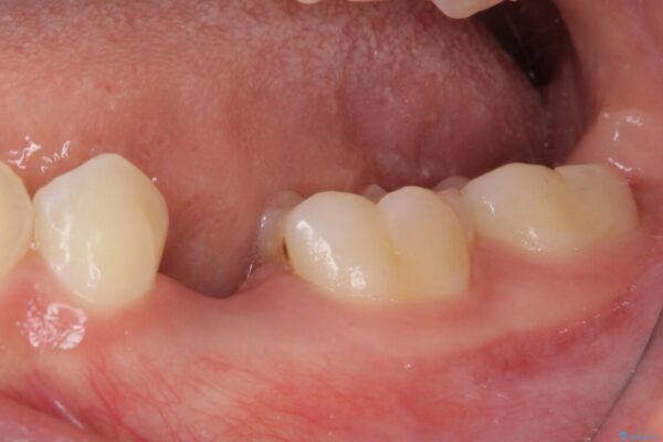 乳歯を抜いてインプラントに　咬み合わせ改善のインビザライン矯正 治療途中画像