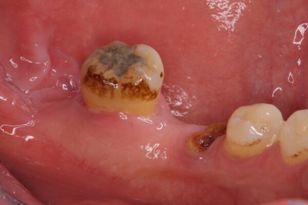 とにかく作り物のような真っ白な歯にしたい　フルジルコニアクラウンによる補綴治療 治療前画像