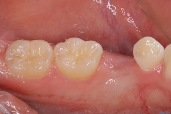 乳歯を抜いてインプラントに　咬み合わせ改善のインビザライン矯正 治療途中画像