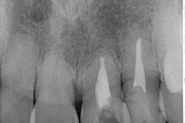 反対咬合で痛む前歯を改善　インビザラインによる矯正治療 治療前画像