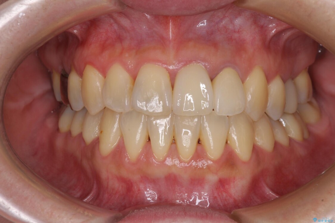 反対咬合で痛む前歯を改善　インビザラインによる矯正治療 アフター