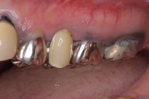 目立つ銀色の奥歯をセラミックに　セラミックブリッジ 治療前画像