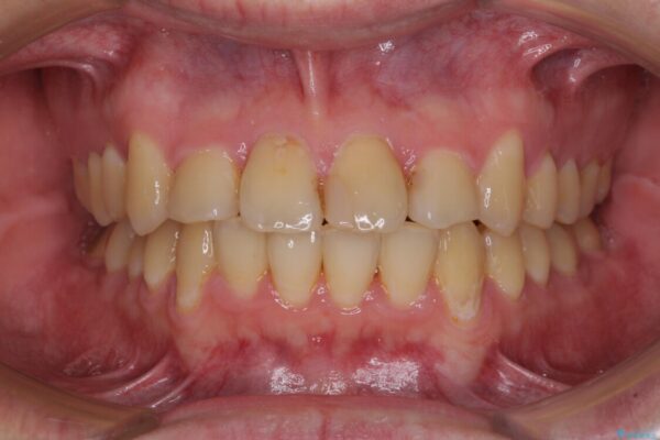 歯列全体のクロスバイトを治したい　ワイヤー装置による矯正治療 治療後画像