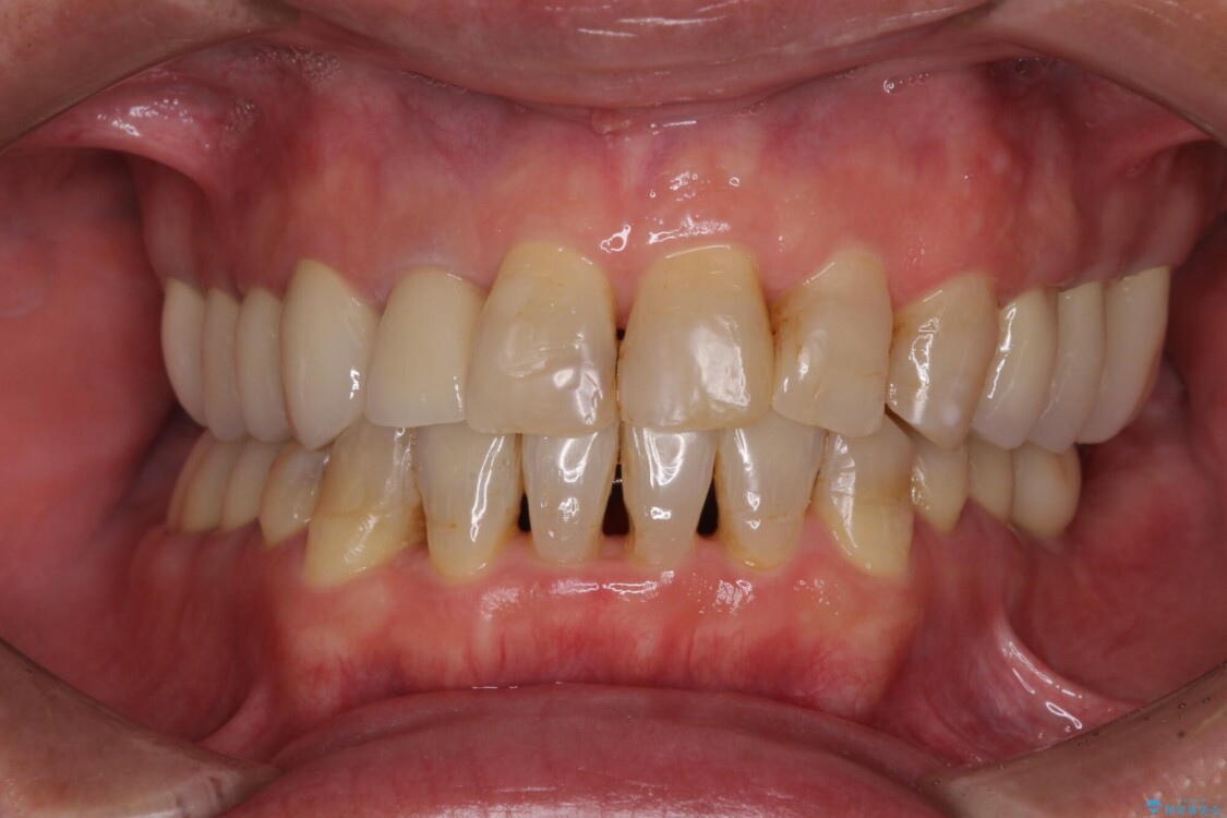 歯列不正と歯周病　総合歯科治療による全顎治療 アフター