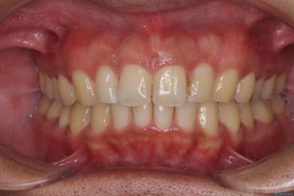 上顎の出っ歯とすきっ歯　補助装置を用いたインビザライン矯正 アフター