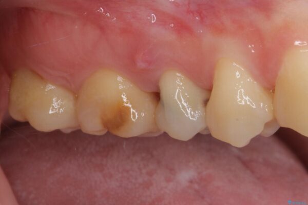神経が死んで変色した歯　根管治療とオールセラミッククラウン 治療前画像