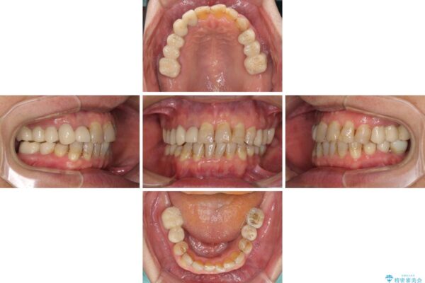 歯列不正と歯周病　総合歯科治療による全顎治療 治療途中画像
