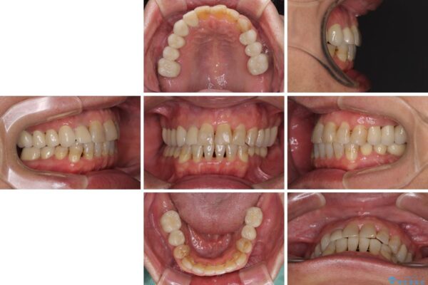 歯列不正と歯周病　総合歯科治療による全顎治療 治療後画像