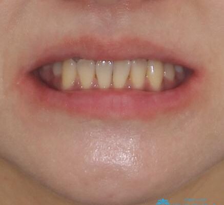 反対咬合で痛む前歯を改善　インビザラインによる矯正治療 治療前画像
